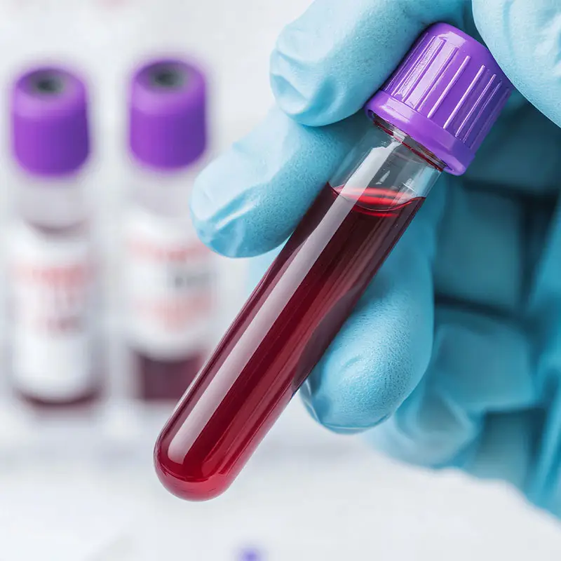 A medical technician wearing surgical gloves holding.a blood sample inside a test tube.